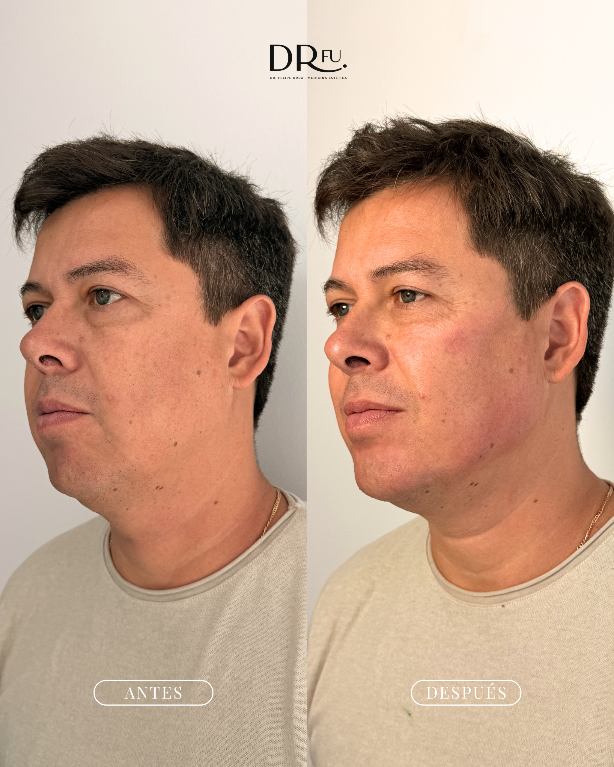 RESULTADO MASCULINIZACIÓN