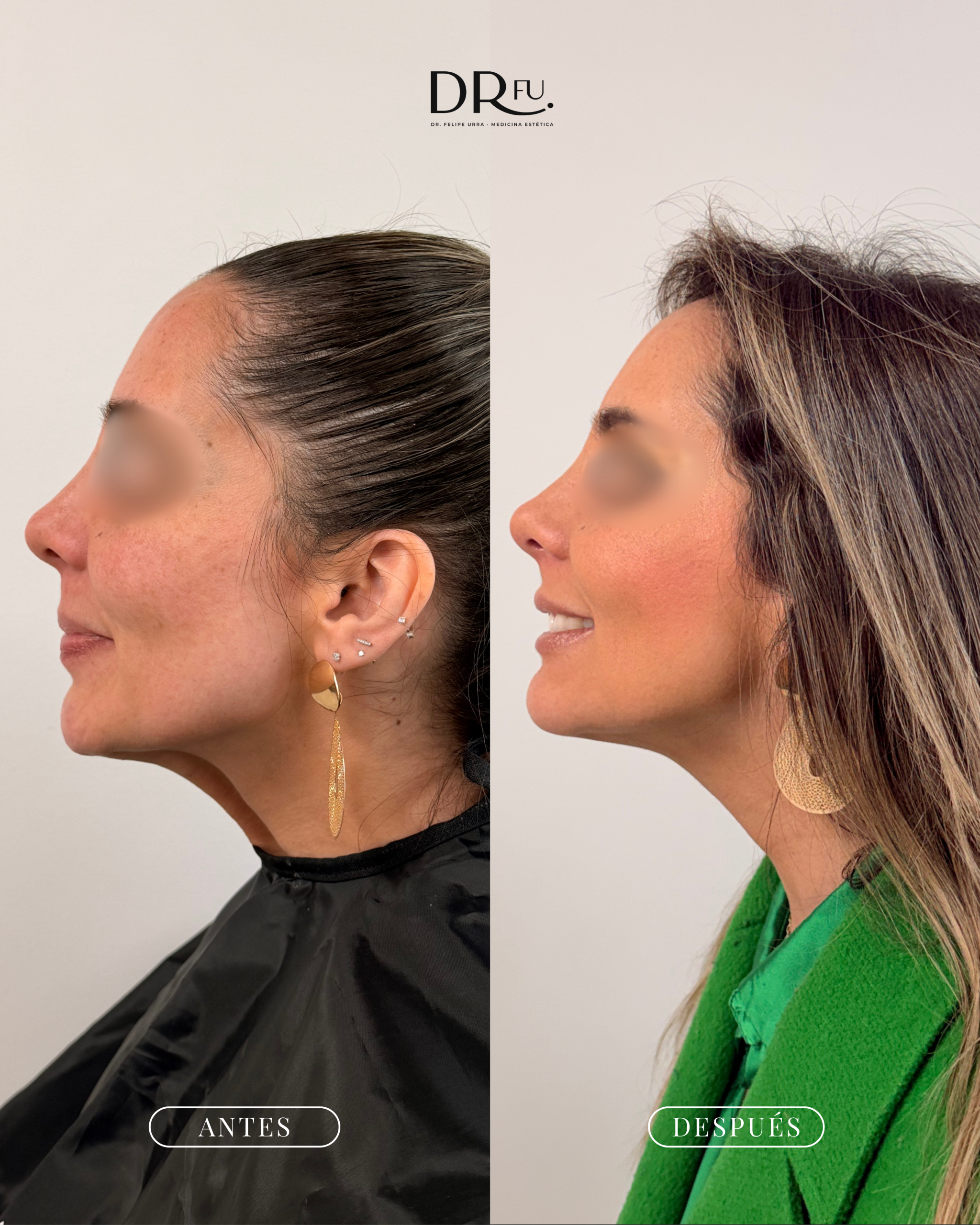 Resultados Full face botox